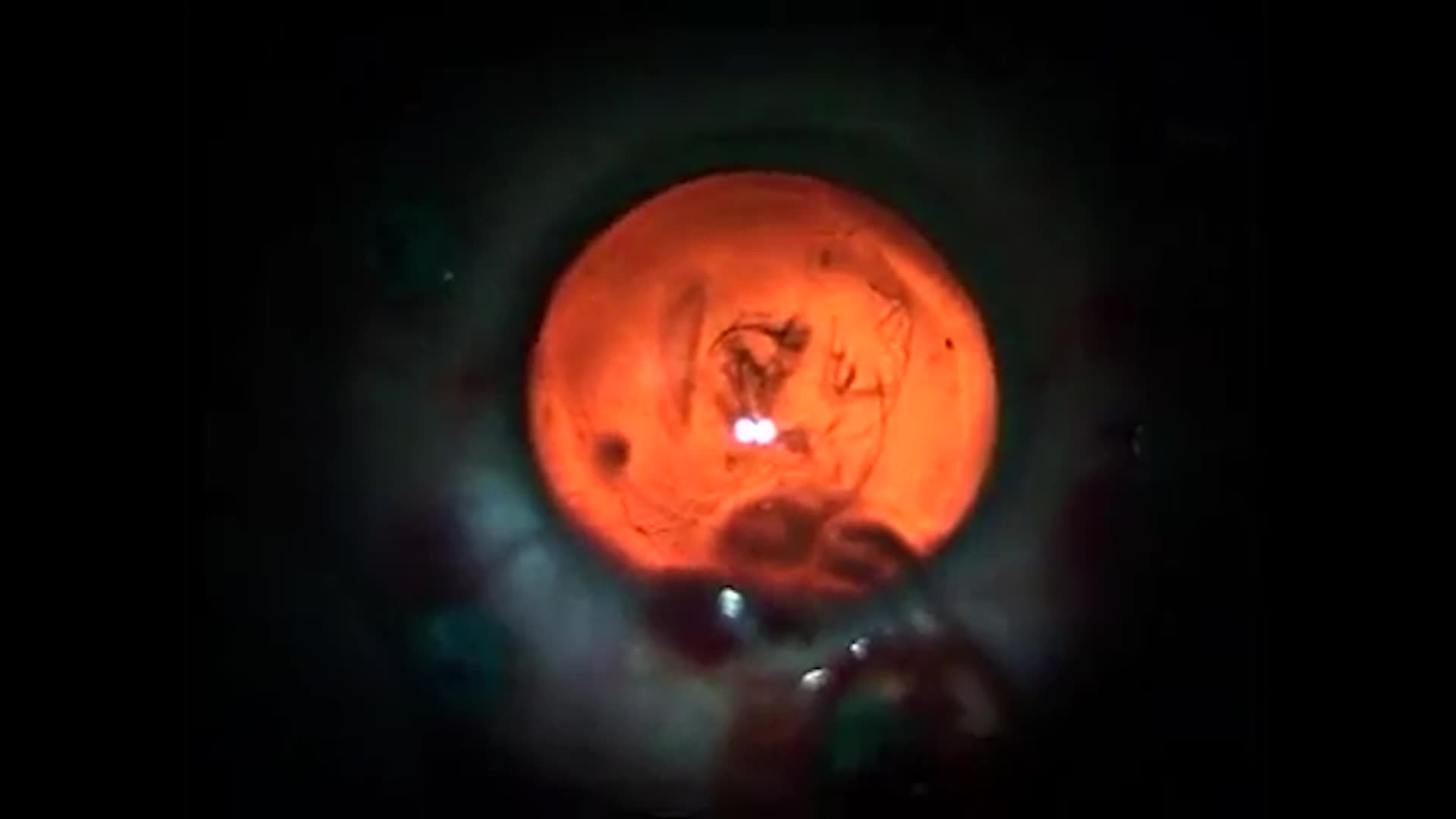 Youtube - Dev Yırtıklı Retina Dekolmanı Cerrahisi
