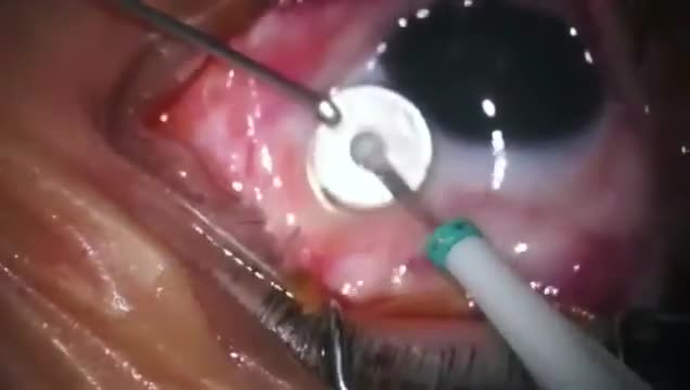 Youtube - Makula Deliği, Kombine Fako Vitrektomi İLM Peeling
