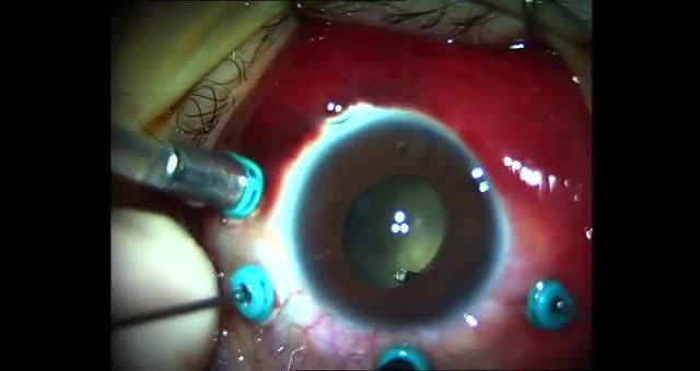 Youtube - Marfan Sendromu Lens Lüksasyonu ve Retina Dekolmanı Cerrahisi