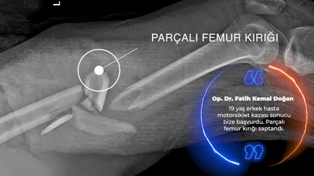 Youtube - Femur kırığı ve tedavisi | Op. Dr. Fatih Kemal DOĞAN