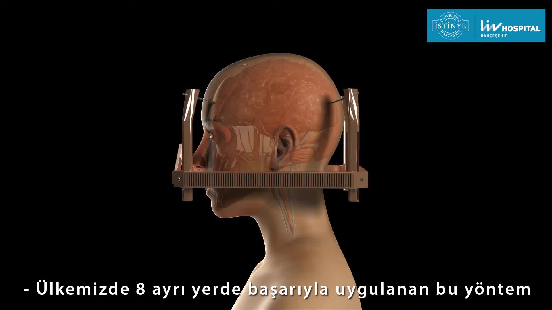 Youtube - GammaKnife Cerrahisi