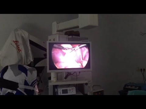76 yaşındaki hastanın safra kesesinden bin 284 taş çıktı