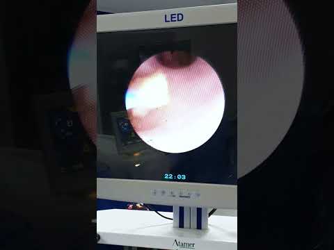 Lazerle Böbrek Taşı Kırma / Op. Dr. Bumin Örs