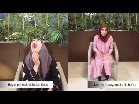 Distoni hastası Aseel Abo Alreeh'in Beyin Pili ile Değişimi | Doç. Dr. Ali ZIRH