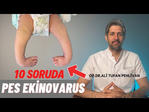 Pes Ekinovarus(PEV, Doğuştan Çarpık Ayak) Nedir? // Pes Ekinovarus, Tedavisi Nasıl Yapılır?