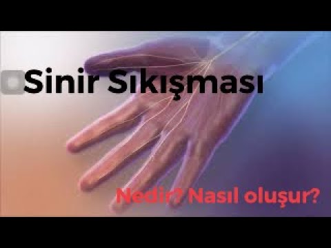 Sinir Sıkışması ( Karpal Tünel Sendromu )