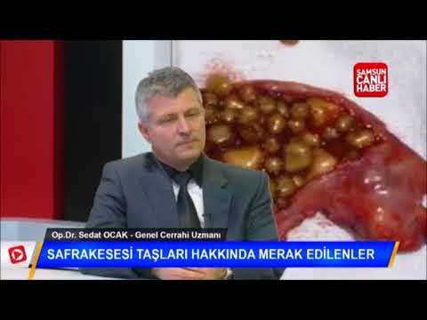SAFRA KESESİ TAŞLARI HAKKINDA MERAK EDİLENLER