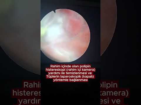 Tüp bağlanması ve histereskopik polip alınması