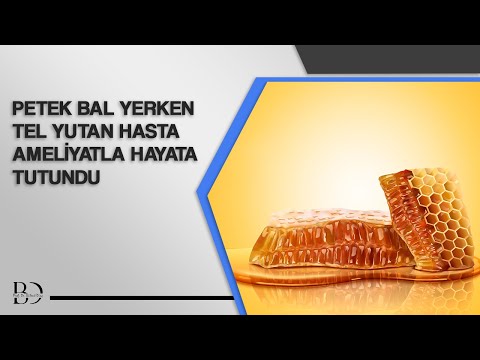 Petek Bal Yerken Tel Yutan Hasta Ameliyatla Hayata Tutundu | TRT Haber | Dr. Bülent Dinç