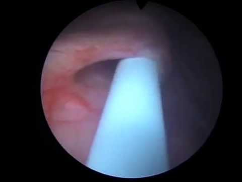 Prof. Dr. Mete Kilciler - Gebelikte Double J Takılması