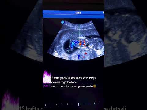 13 haf. gebelik ,ikili tarama testi ve detaylı anatomik değerlendirme.