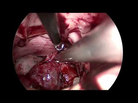 RÜPTÜRE ETMEDEN V-NOTES YÖNTEMİ İLE 9 CM DERMOİD KİST EKSİZYONU