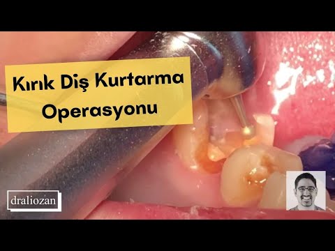 Kırık Diş Nasıl Kurtarılır? | (Tüm Detaylarıyla) | Azı Dişinde Kırık ve Çürük