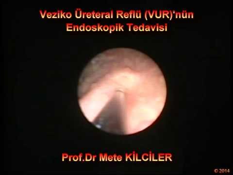 Veziko Üreteral Reflü (VUR)' nün Endoskopik Tedavisi - Profesör Doktor Mete KİLCİLER