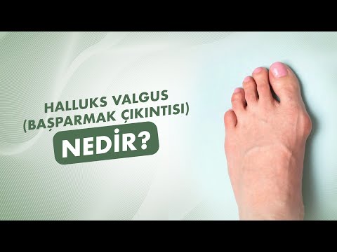 Halluks Valgus (Başparmak Çıkıntısı) Nedir?