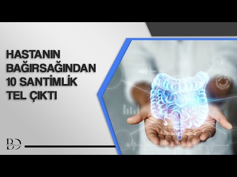 Hastanın Bağırsağından 10 Santimlik Tel Çıktı | TRT 1 | Dr. Bülent Dinç