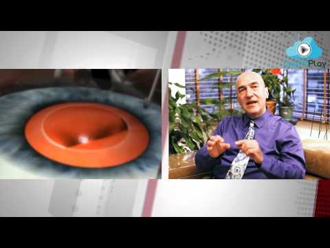 Katarakt nedir?