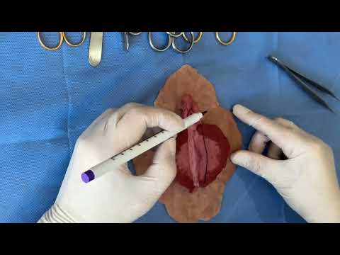 Labioplasti Ameliyatı Nasıl Yapılır ? - Doktor İrem Yengel
