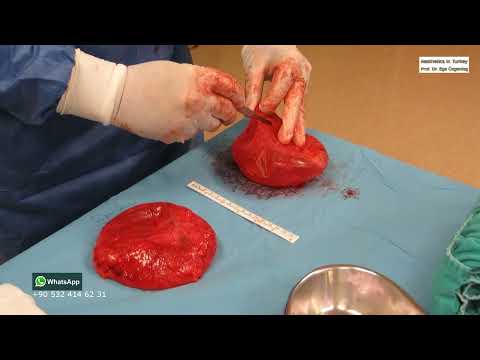 Removing the breast implant