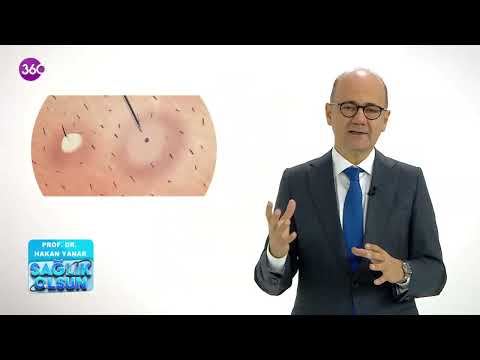 Kıl Dönmesi ve Tedavi Yöntemleri Prof Dr Hakan Yanar