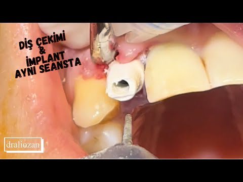 İMPLANT DİŞ NASIL YAPILIR ? | Tek Seansta Diş Çekimi ve İmplant Uygulaması
