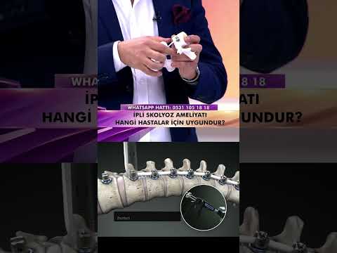 İpli Skolyoz Ameliyatının Klasik Skolyoz Ameliyatından Farkları Nelerdir?