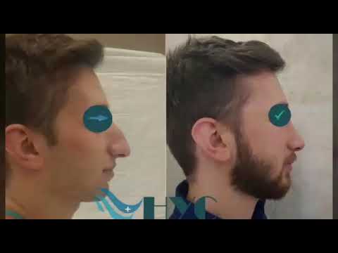 Burun Estetiği Öncesi Sonrası