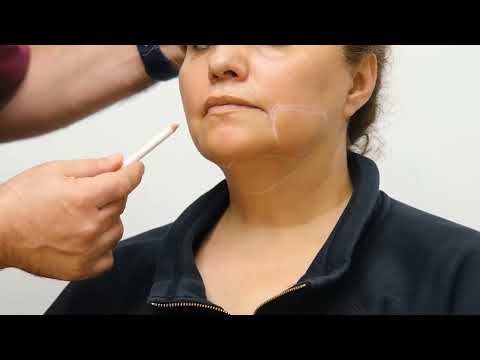 Yüz ve Gıdı İnceltme - DesoFace - Uzm. Dr. Şerafettin Saraçoğlu