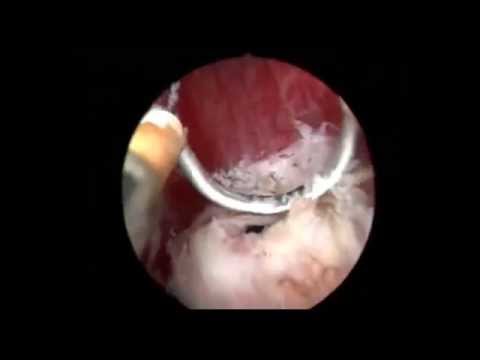 Profesör Doktor Mete KİLCİLER - Obstruktif İnfertilite Tedavisinde