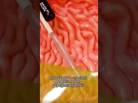 Mide Balonu nedir? Nasıl uygulanır?