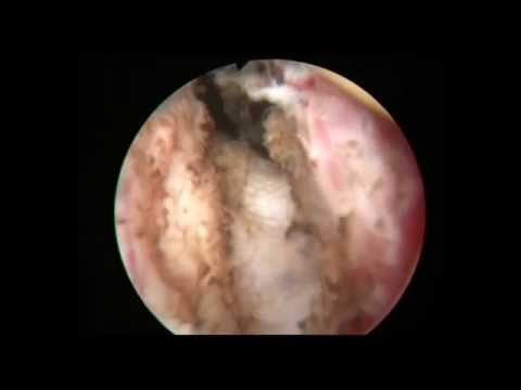 Profesör Doktor Mete KİLCİLER - Prostat İnsizyonu