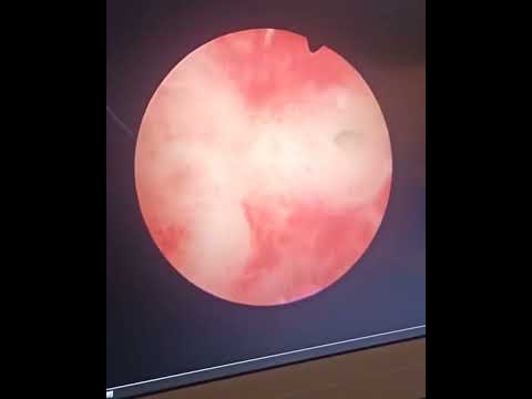 Histeroskopi ile endometrial polip tedavisi