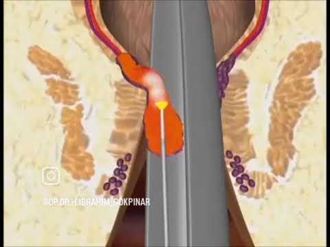 Lazer İle Hemoroid Ameliyatı