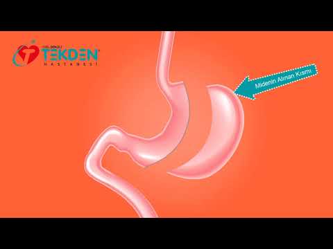 TÜP MİDE ANİMASYON