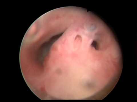 Profesör Doktor Mete KİLCİLER - Veru Montanum Yapışıklığı