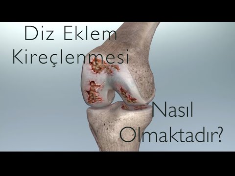 Diz kireçlenmesi nasıl olmaktadır?