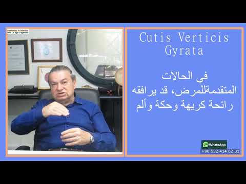 مرض CVG تجعدات قشرة الرأس