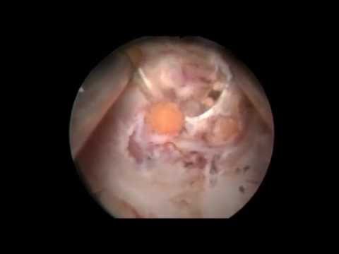 Profesör Doktor Mete KİLCİLER - Prostat Taşları