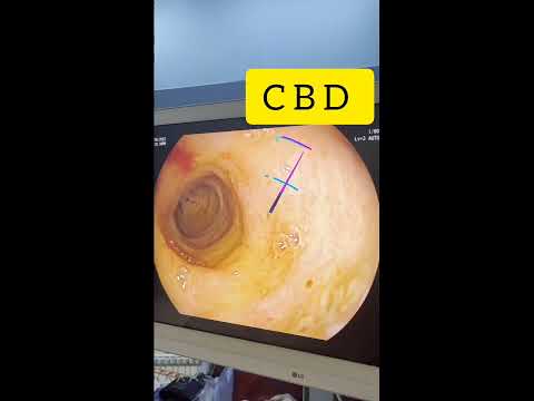 Peroral Cholangioscopy (Safra yolu Endoskopisi)