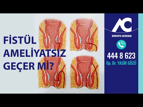 Anal Fistül Ameliyatsız Geçer mi?