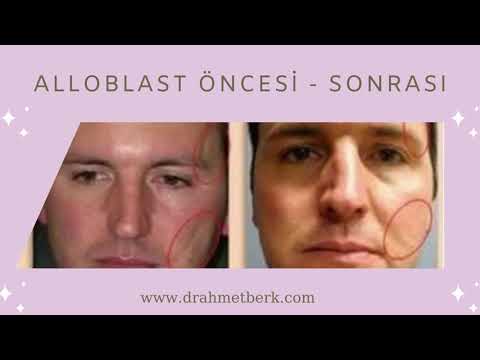 Dermatolog Uzm. Dr. Ahmet Berk ( ALLOBLAST NEDİR ? )