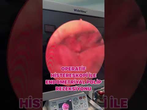 Operatif Histeroskopi İle Endometriyal Polip Rezeksiyonu 👌🏻