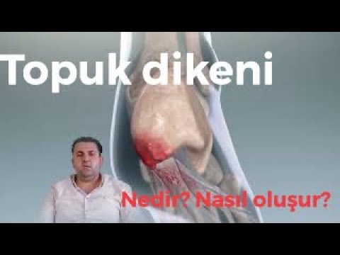 Topuk dikeni (plantar fasitis)