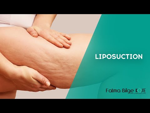 Liposuction Nedir? | Dr. Fatma Bilge KÖSE