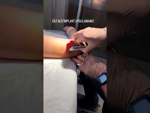 Cilt altı implant uygulamamız 💉 #implant