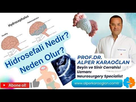 HİDROSEFALİ Hastalığı Nedir? Neden Olur? | Prof.Dr. Alper KARAOĞLAN