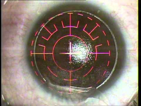 Lazer Lasik