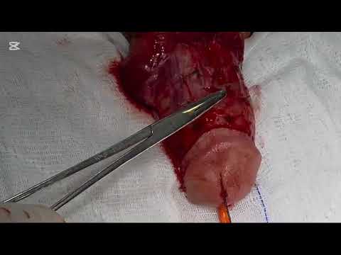 ERİŞKİN YAŞ SEKONDER HİPOSPADİAS ONARIMI
